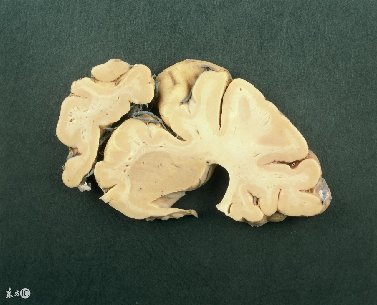 北京高新戒毒医院刘连清主任：*毒冰**后常见症状与危害？