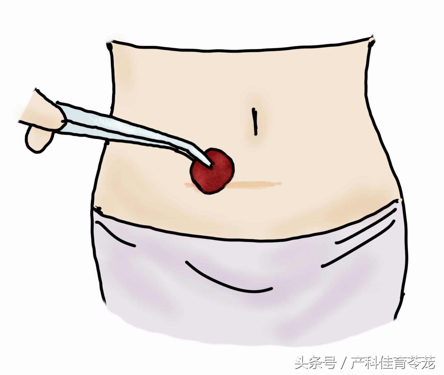 剖宫产术后切口回声改变,剖宫产术后切口改变有问题吗