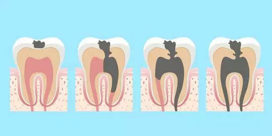 蛀牙是不是虫子钻的,蛀牙是真的因为有虫子吗