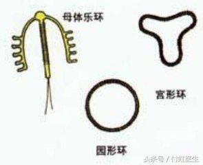 带环一年了小腹经常痛白带有血,白带有血丝和上环有关系