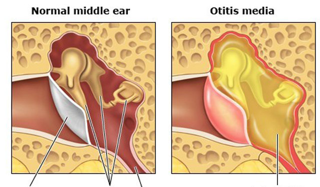 小儿中耳炎怎么治最快最有效,儿童中耳炎的正确处理方法及原因