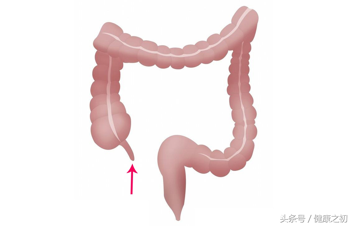 阑尾癌症中晚期能治愈吗,阑尾切除易得癌症