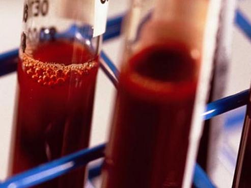 孩子尿尿是红色有事吗,孩子尿带有点血色是什么原因