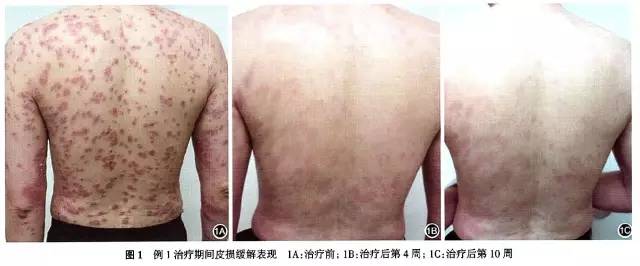 银屑病生物制剂可善挺,银屑病用生物制剂效果如何