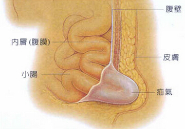 疝气腹腔镜手术后有哪些注意事项,老年人疝气手术后饮食注意事项