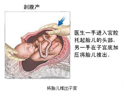 剖腹产全过程,剖腹产20天伤口真实照片