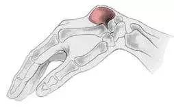 手腕血管周围有肿块是怎么回事,手腕上有突出的肿块能按摩下去吗