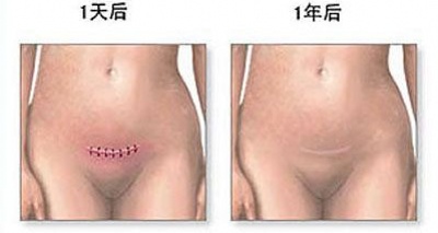 对于选择剖腹产的孕妈妈而言,到底剖腹产是怎样的?(图解)