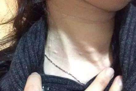 脖子发胀难受怎么回事怎么调理,脖子出现这三种特征可能已患大病
