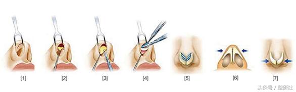 女生怎么逆袭蒜头鼻,女生通天鼻怎么修