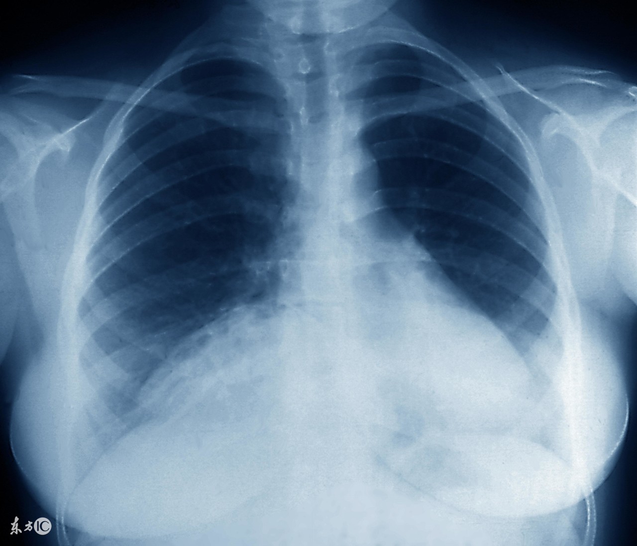 支原体肺炎输液七天还是反复咳嗽,两岁宝宝肺炎支原体感染反复咳嗽