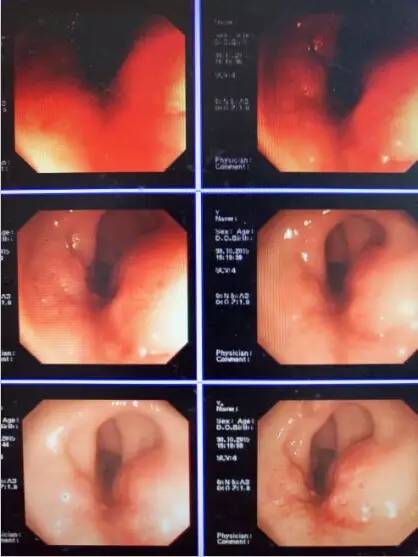 直肠神经内分泌肿瘤转移概率,直肠恶性肿瘤转移肝瘤严重吗