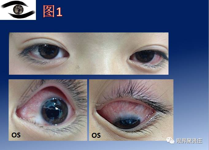 几种眼病的视野图,看图识病是什么病