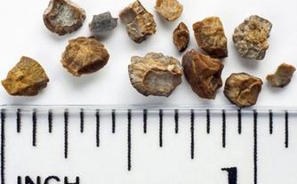 尿路结石症状和膀胱癌症状的区别,上尿路结石最常见的典型症状是