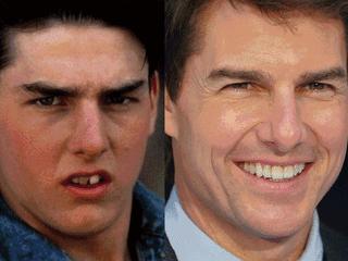 隐形矫正免费试戴,《芳华》女主也来打Call