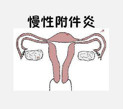 久坐引发炎症,为啥会得附件炎