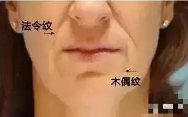 做完线雕真的会年轻吗,经常做线雕面部会年轻吗