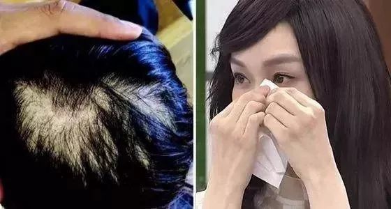 产后发际线后移怎么办,产后脱发发际线脱得最厉害