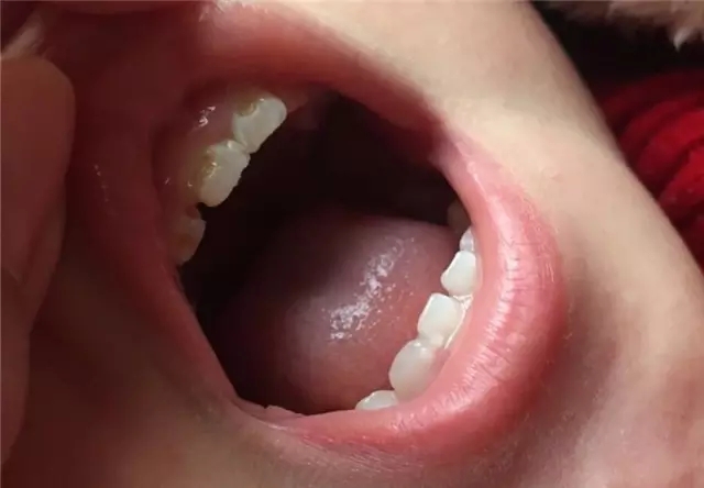 如何预防奶瓶龋?宝宝奶瓶龋了怎么办