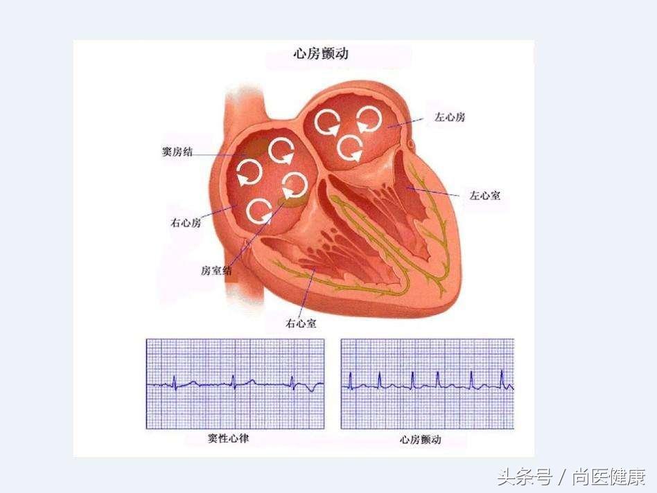 房颤的4大主要表现，带你全面了解房颤