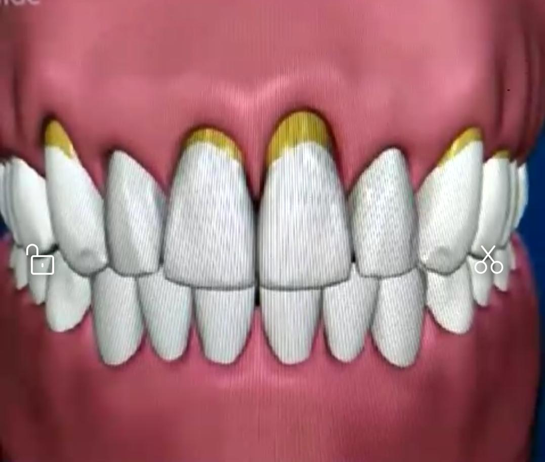 早期牙周病的症状,什么是牙周病及症状表现