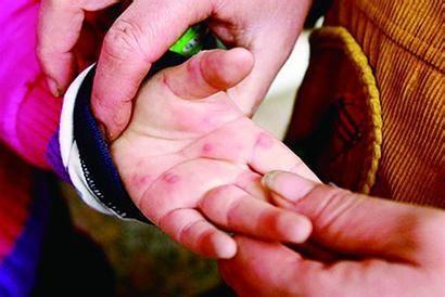 手足口病究竟是什么，如何科学防治？