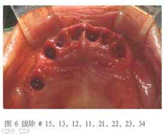 拔牙拆线后需要注意什么,小孩牙齿怎么判断可以拔了