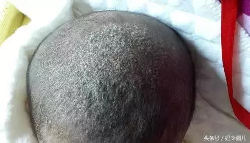 宝宝额头上的乳痂怎么去掉,新生儿脸上奶痂怎么消除