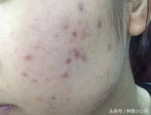 手贱抠痘后抹什么药,手贱挤痘了怎么办