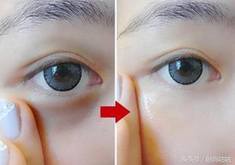 有眼袋怎么消除请问专家,有眼袋怎么消除不用任何物品