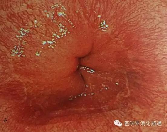 barrett食管的症状是什么,barrett食管是什么意思