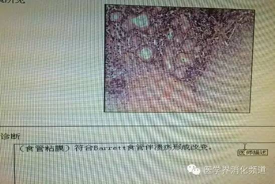 barrett食管的症状是什么,barrett食管是什么意思