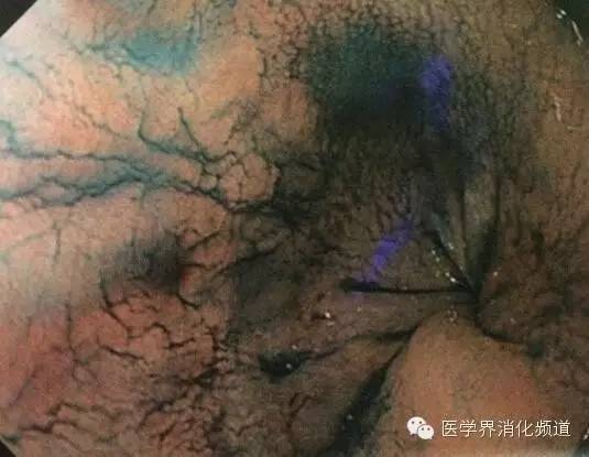 barrett食管的症状是什么,barrett食管是什么意思