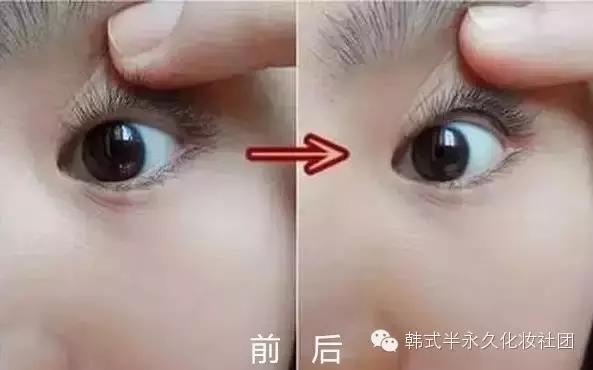 纹美瞳线七天脱痂过程图,纹美瞳线掉痂后反色过程图