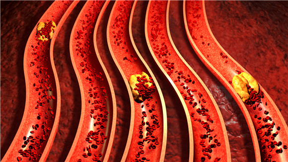 动脉硬化症状怎么治疗,动脉硬化什么症状如何检查治疗