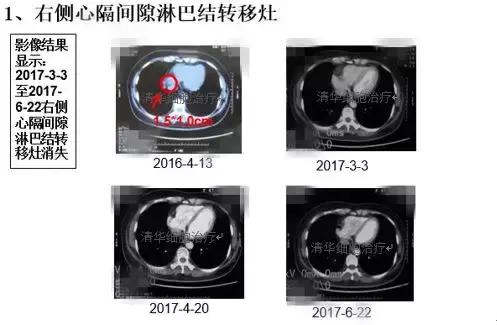 2023nkt细胞治疗肺癌效果,nkt肺癌免疫治疗