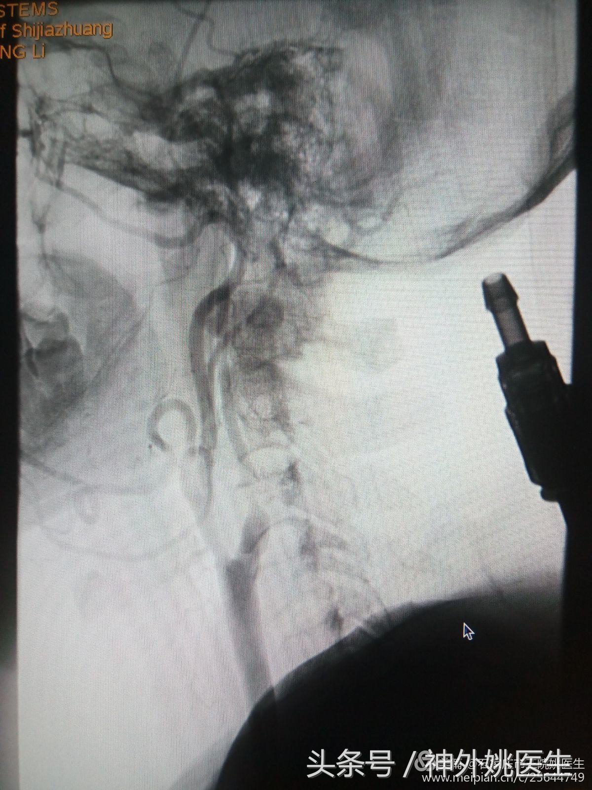 颈内动脉狭窄可以做内膜剥脱术吗,颈内动脉内膜剥脱手术指征
