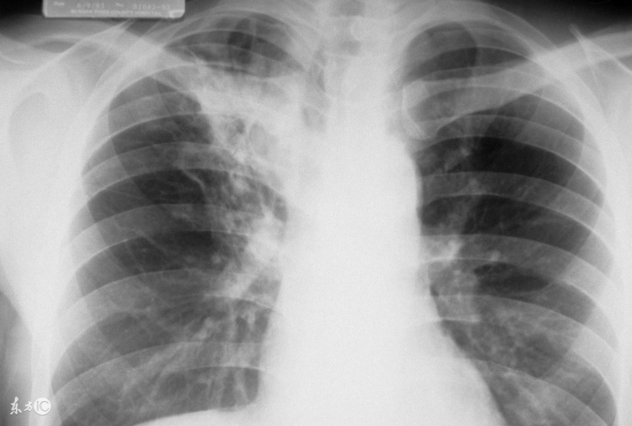 已确诊是结核病人怎么办,结核病并发症一览表