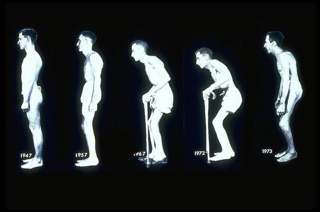 强直性脊柱炎的临床诊断,强直性脊柱炎诊断标准与治疗