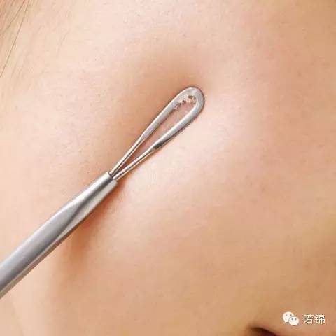 挤黑头过程留一个坑,挤黑头的工具如何使用图解