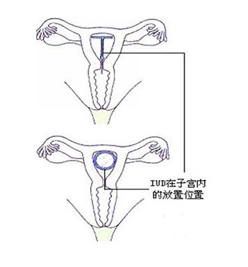 上环是避孕最好的方法吗?对身体会造成什么危害呢?