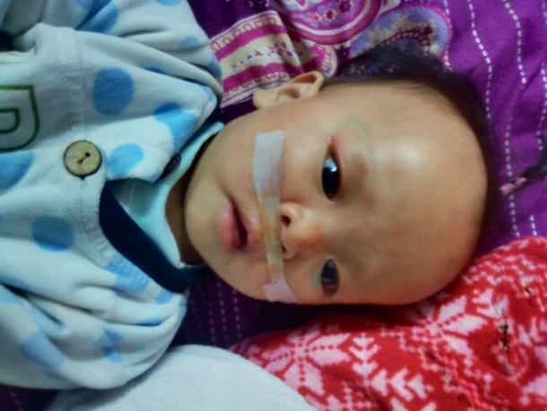 婴儿单纯先天裂唇7毫米,先天性腭裂是什么