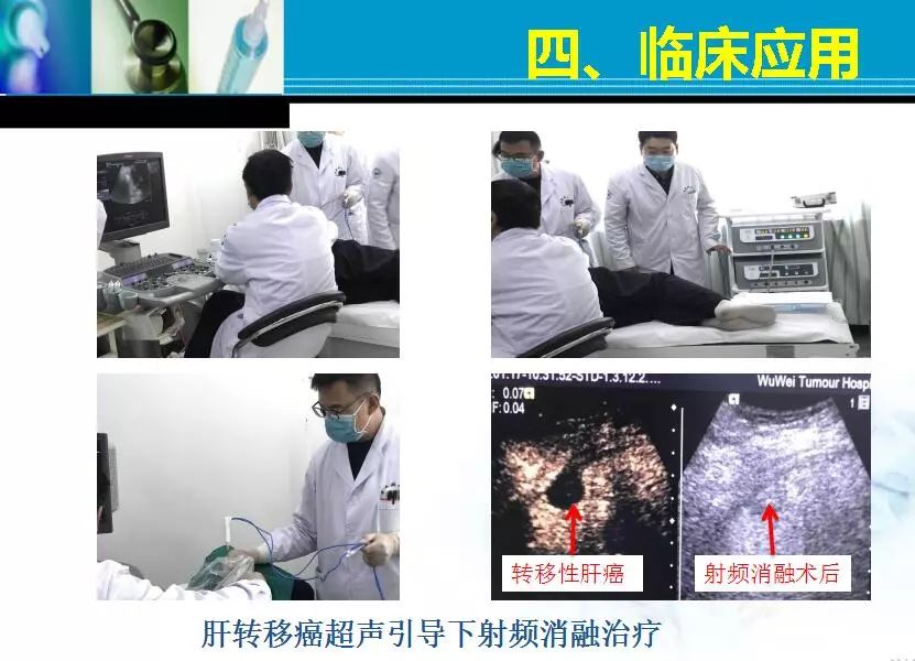 胆管肿瘤射频消融术,肿瘤射频消融厂家