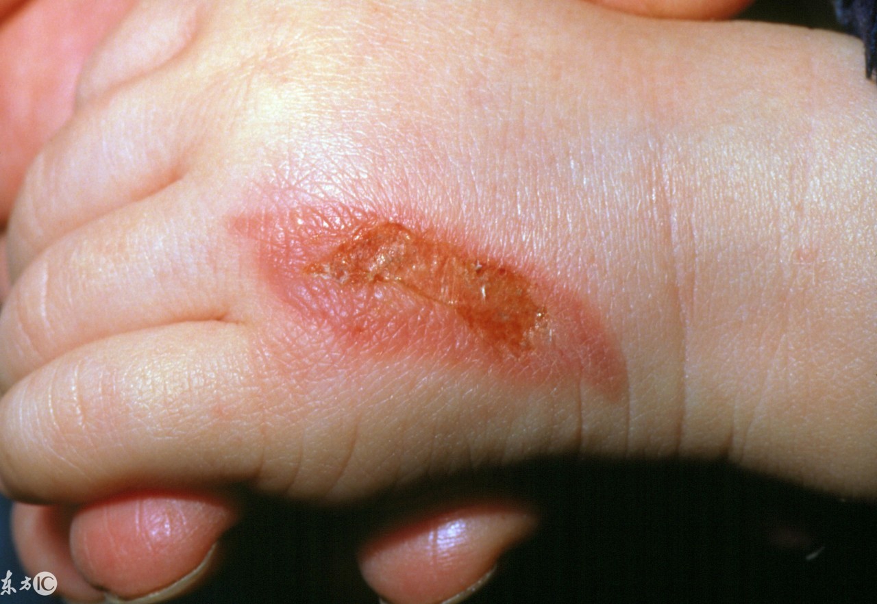 被开水烫伤怎么办最快最有效止疼,被开水烫伤应该怎么缓解