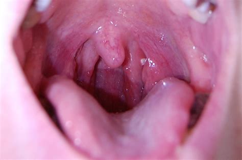 扁桃体隐窝有菌团属于病灶吗,扁桃体隐窝处长块息肉有什么危害