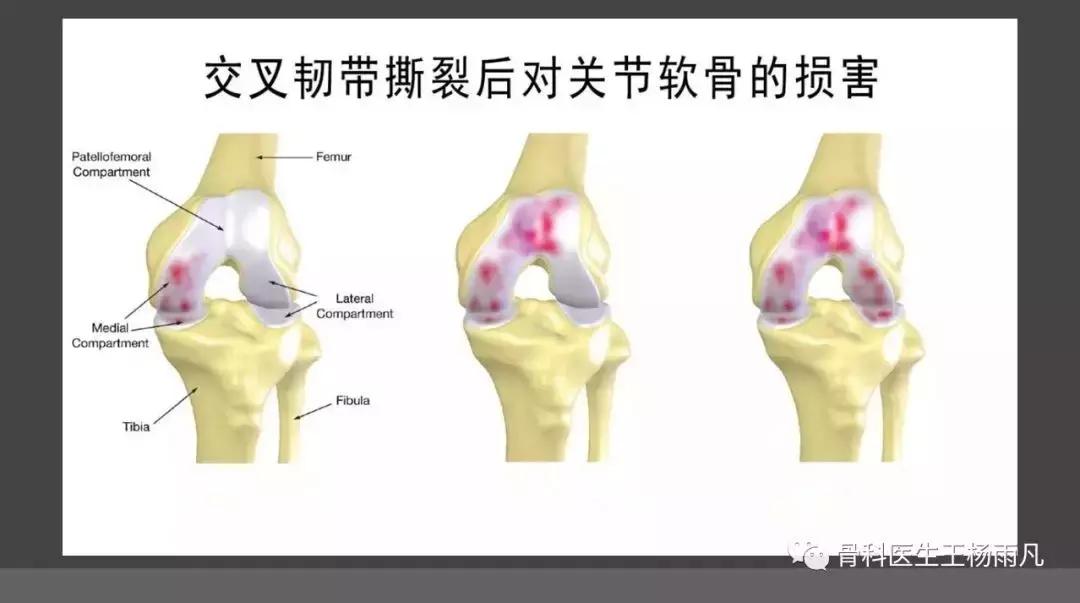 前叉韧带损伤最佳治疗方法,前交叉韧带重建后前叉先松后紧