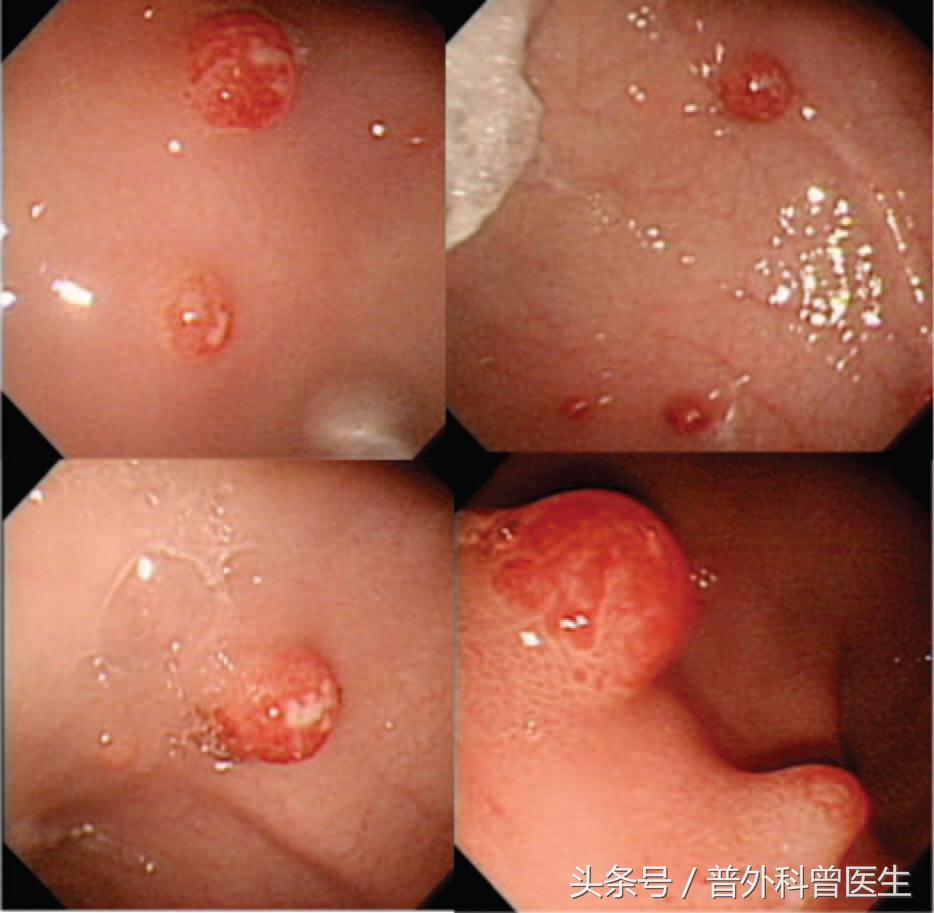 爸爸有肠息肉儿子也有是遗传吗,自己长肠息肉会遗传到孩子吗