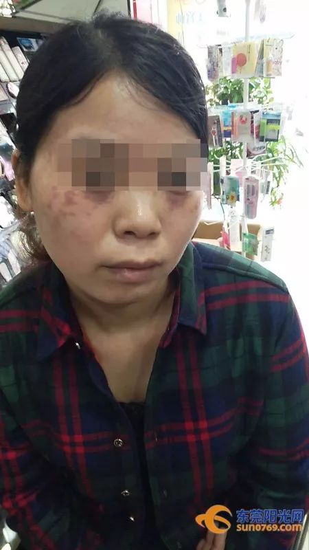 面部祛斑遭毁容,祛斑毁容真实案例