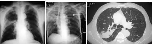 如何通过肺ct看出自己得了肺炎,肺ct怎么看出是病毒还是细菌