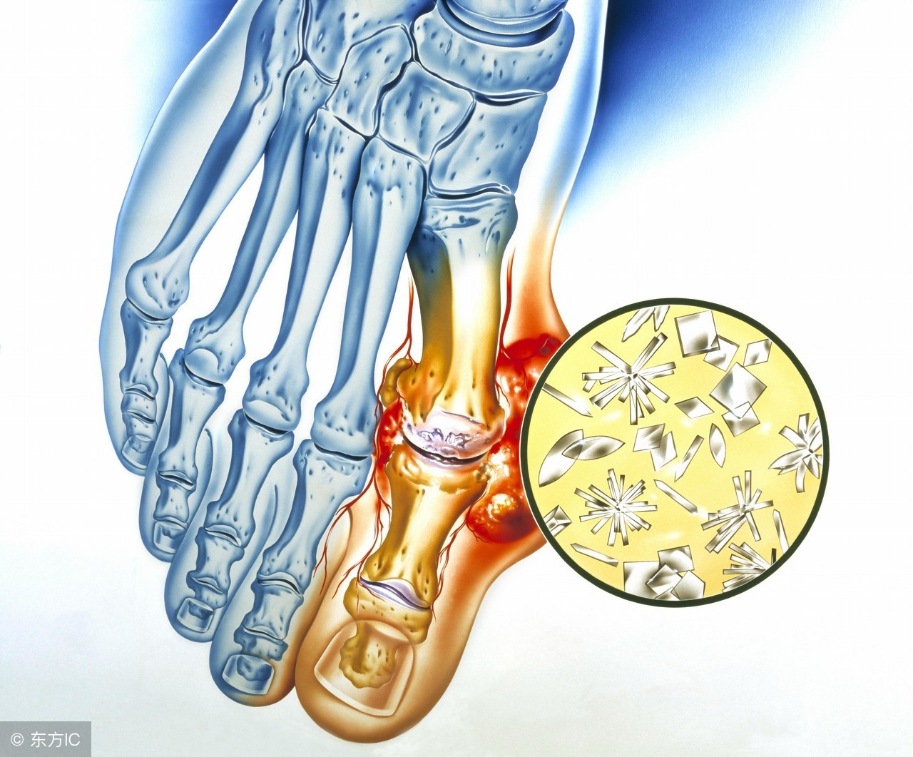 痛风的营养饮食疗法：这6大饮食原则及所需营养，你都吃对了吗？